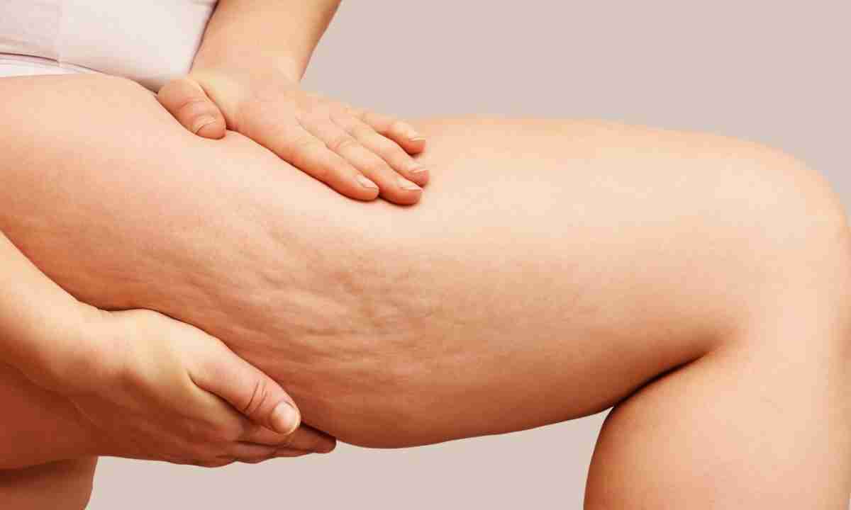 Kaffee-Kokosöl-Mischung zur Reduzierung und Vorbeugung von Cellulite – wie man sie anwendet